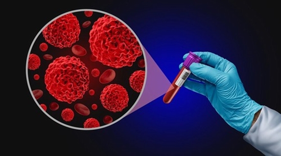 تشخیص زودهنگام سرطان با آزمایش خون 